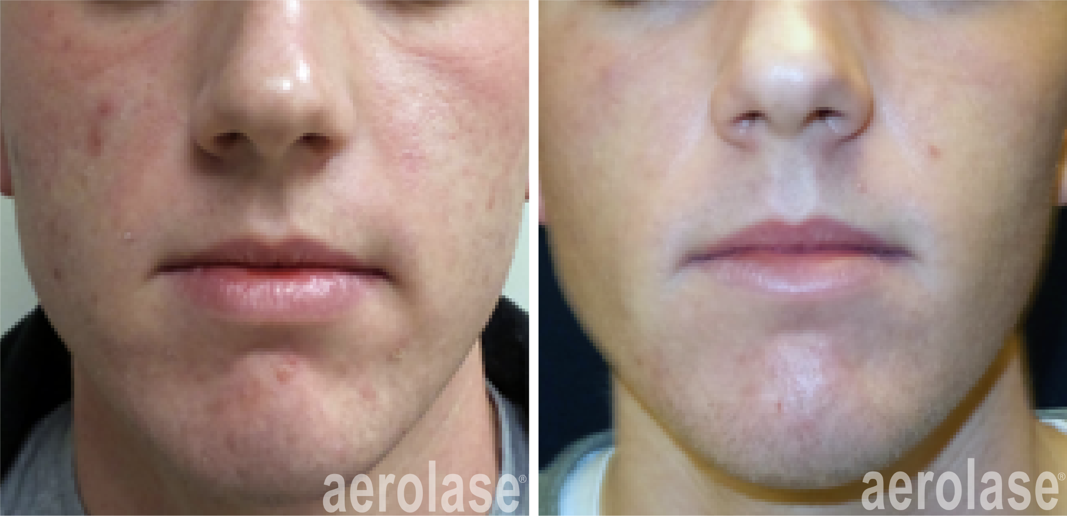 Laser Treatment for Acne Scarring Near Joliet Illinois