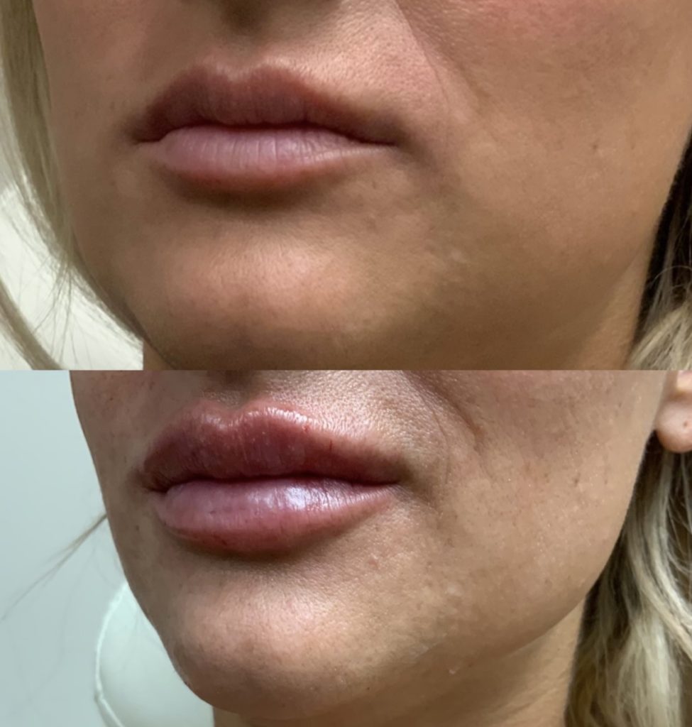 lip enhancement injections