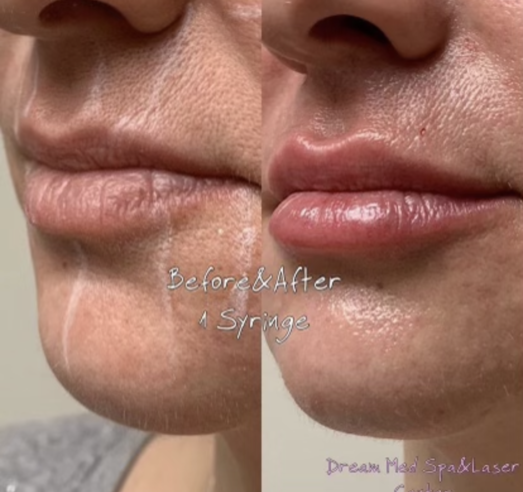 best lip fillers near joliet illinois