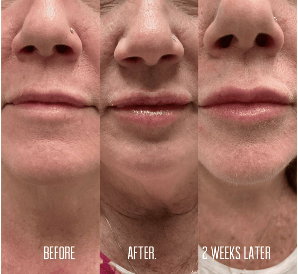 lip filler progression 