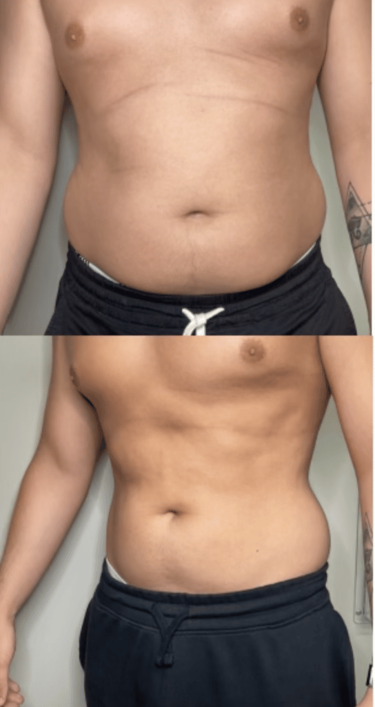 stomach fat burner laser