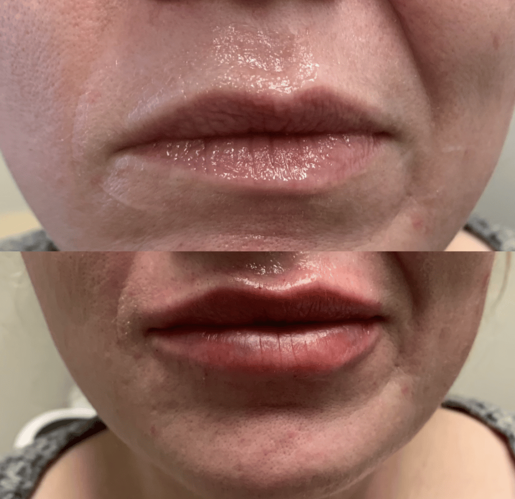 lip flip injections plainfield