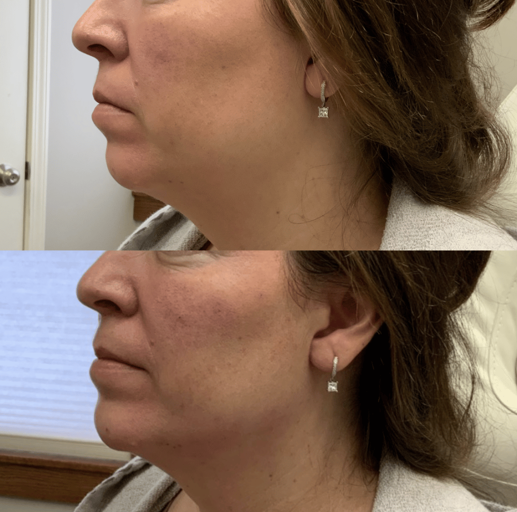 restalyne double chin filler for reduction