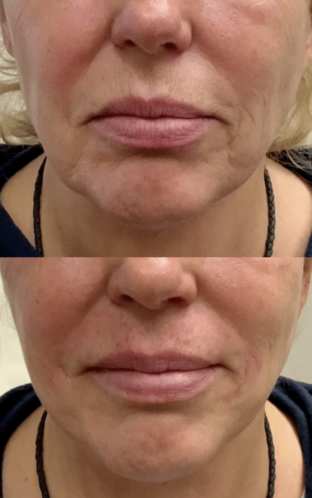 lip filler for aging lips