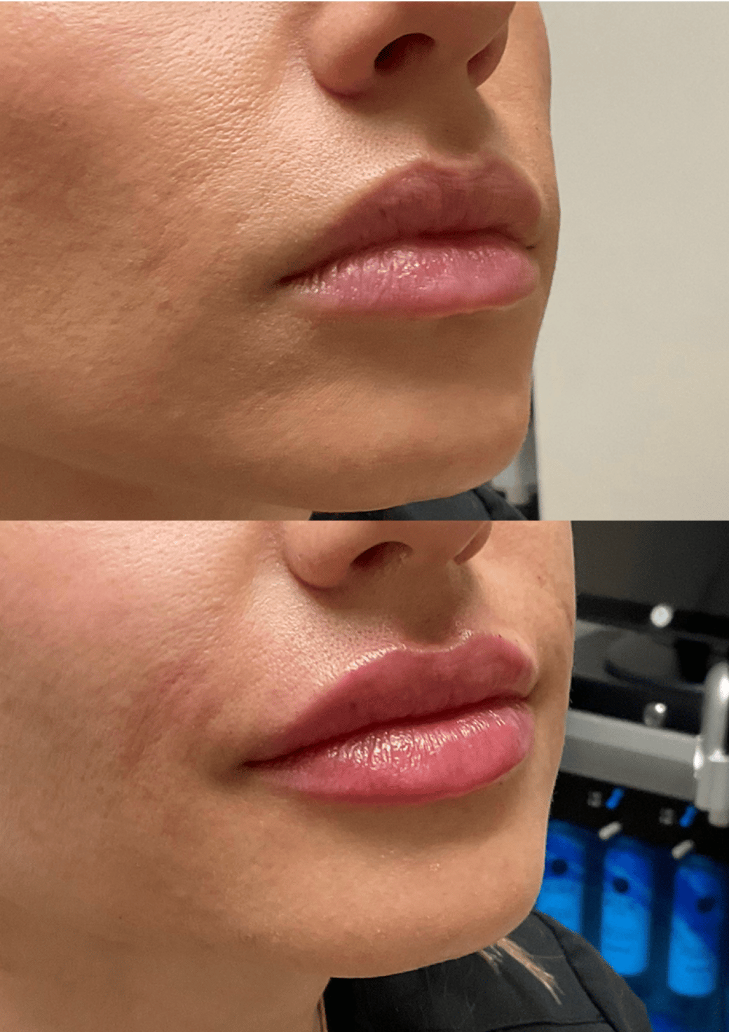 best lip fillers near joliet