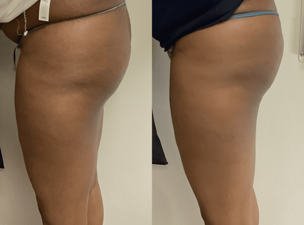 laser skin resurfacing near joliet illinois