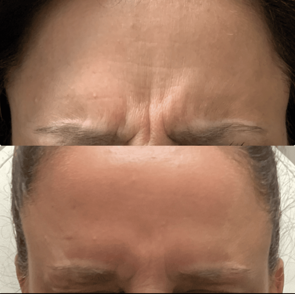 frown lines botox joliet