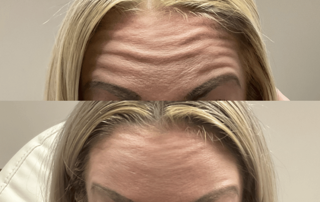 botox for forehead lines