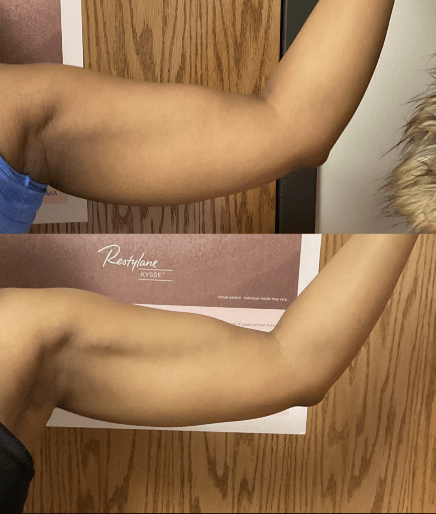 arm toning laser
