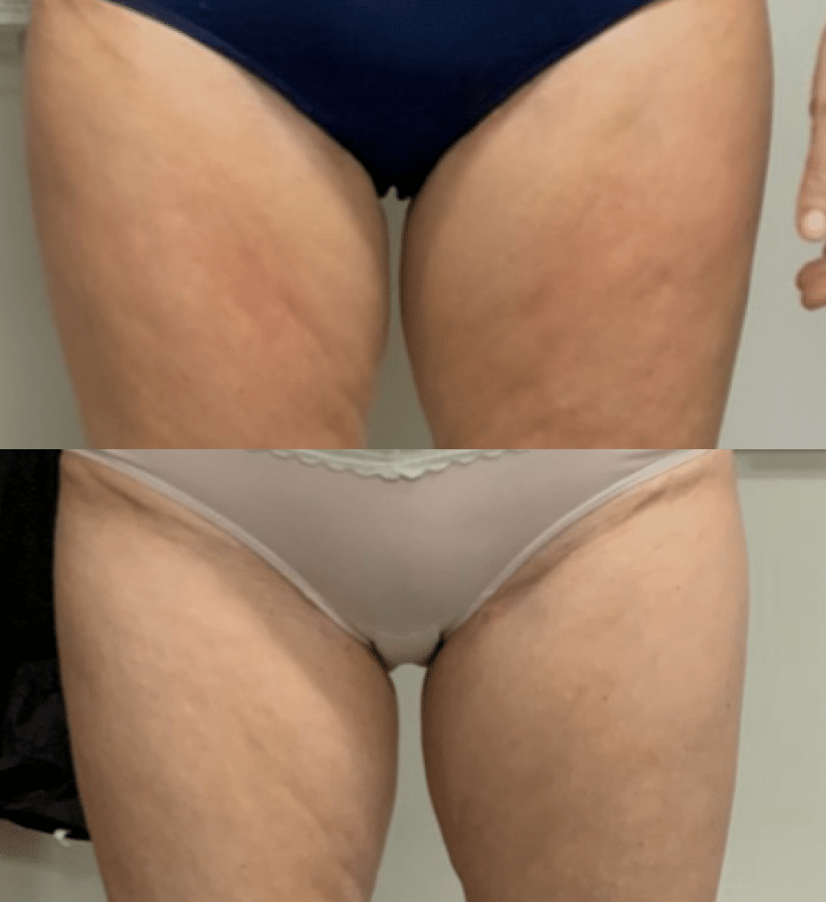 laser treatment for inner thighs