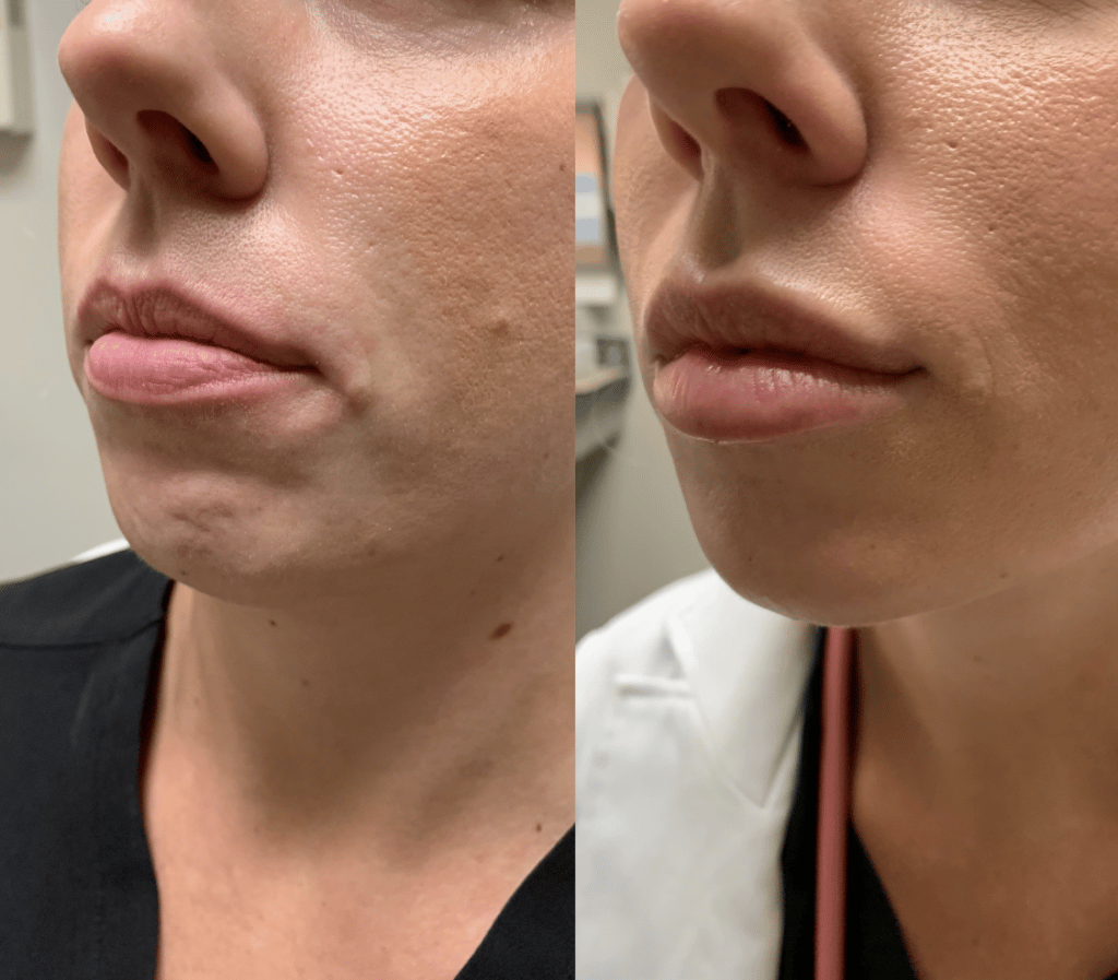 injections for fuller lips
