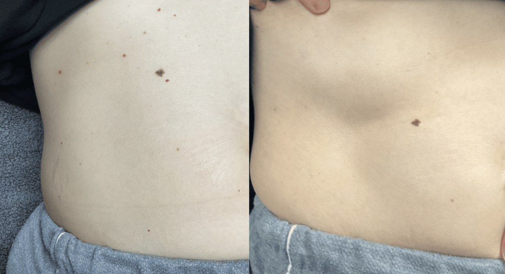 rosacea laser treatment near joliet il