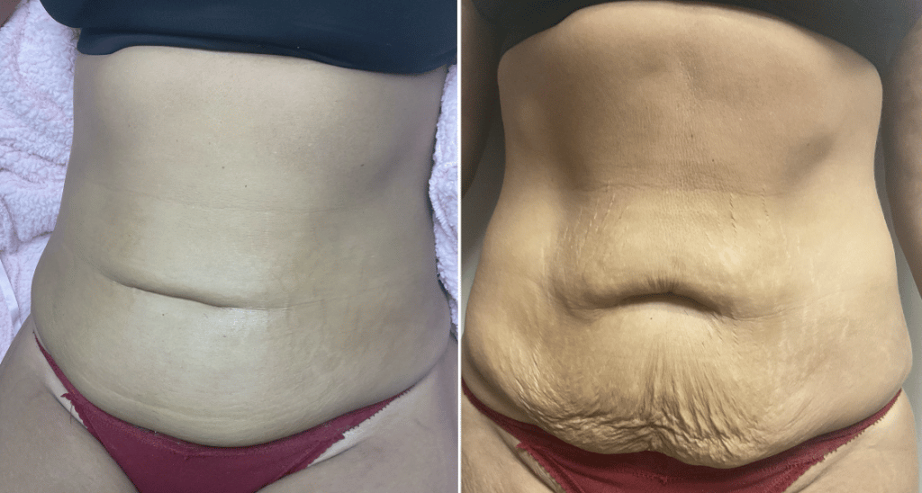 laser stomach toning joliet illinois