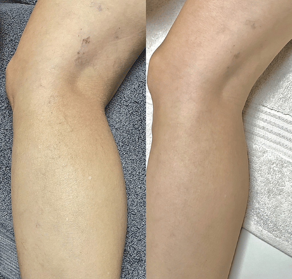 vericose veins removal plainfield il