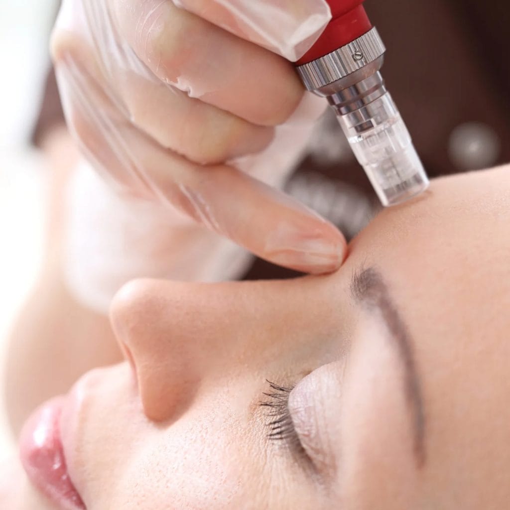 patient receiving microneedling skin treatment at dream med spa & laser center in plainfield illinois