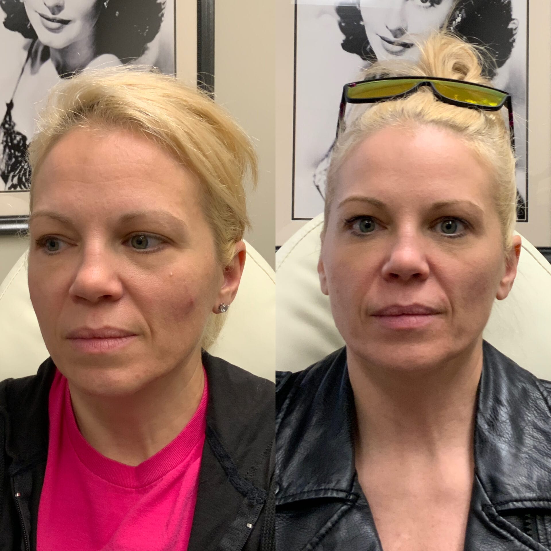 Sculptra, Botox, and filler used for comprehensive anti-aging results