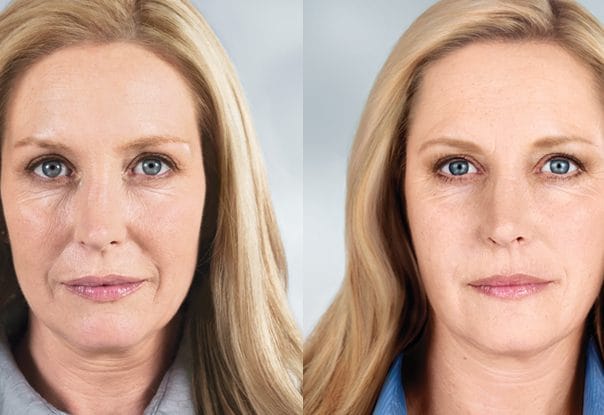 before and after of a patient after receiving Sculptra
