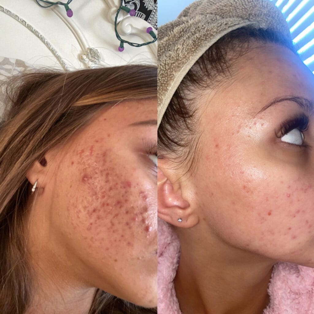 Combination of Lasemd and chemical peel for skin resurfacing