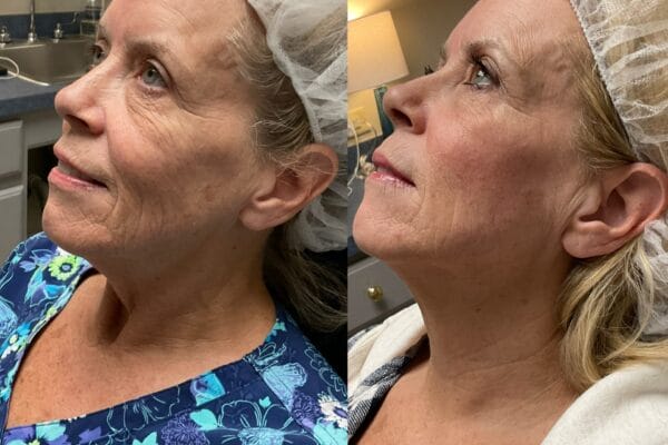 Patient Results from a Combination of LaseMD and Infini RF Lasers