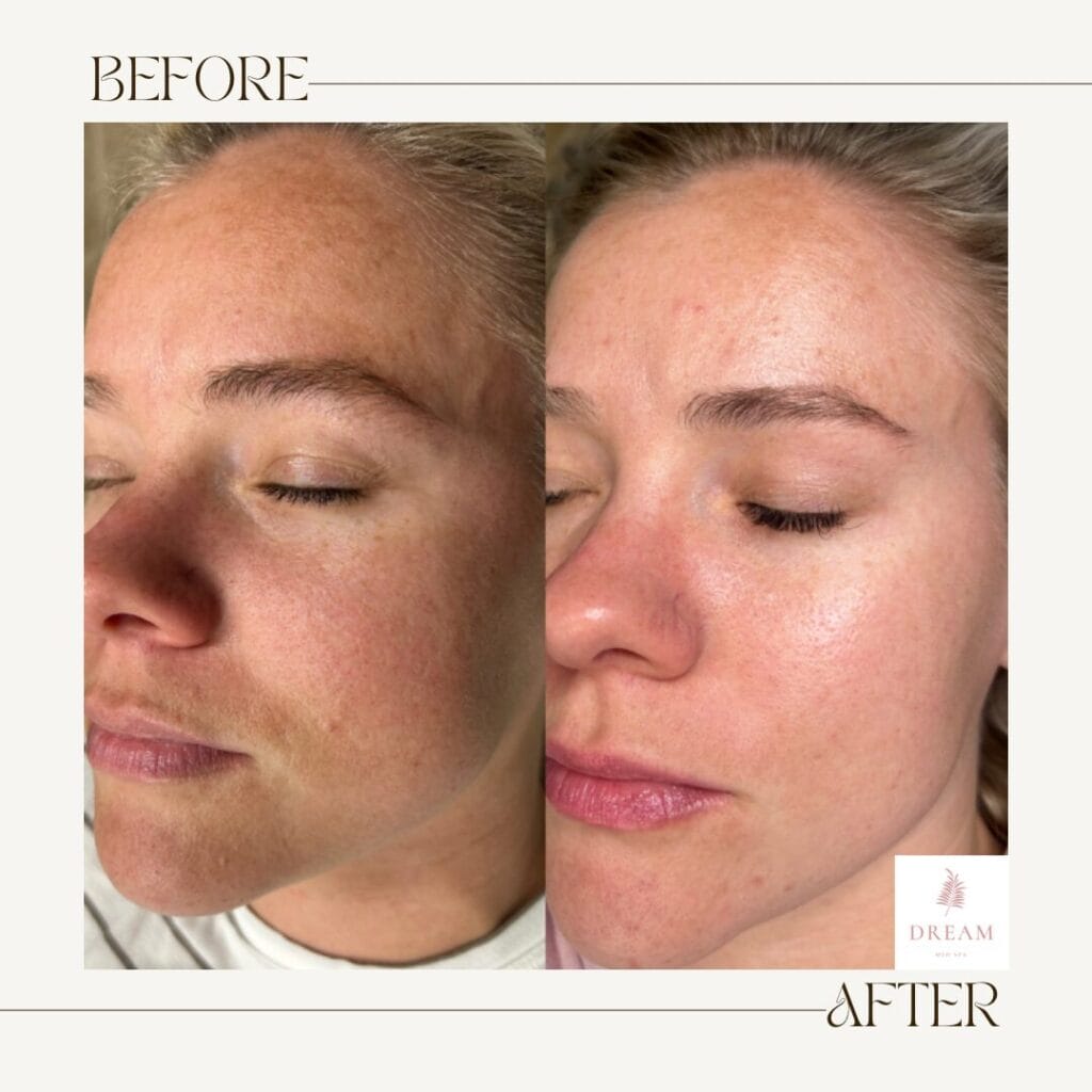 before and after of a patient after getting a professional chemical peel
