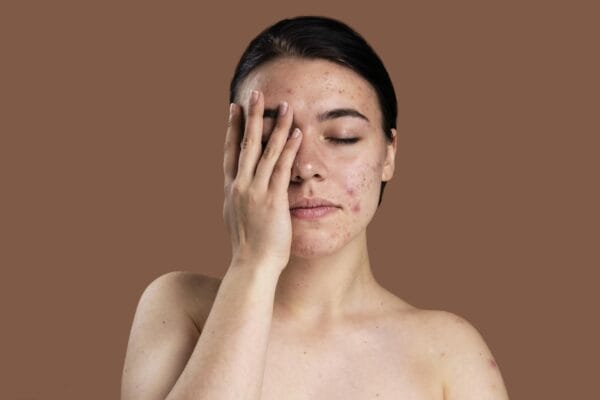 young woman with acne breakouts on her face