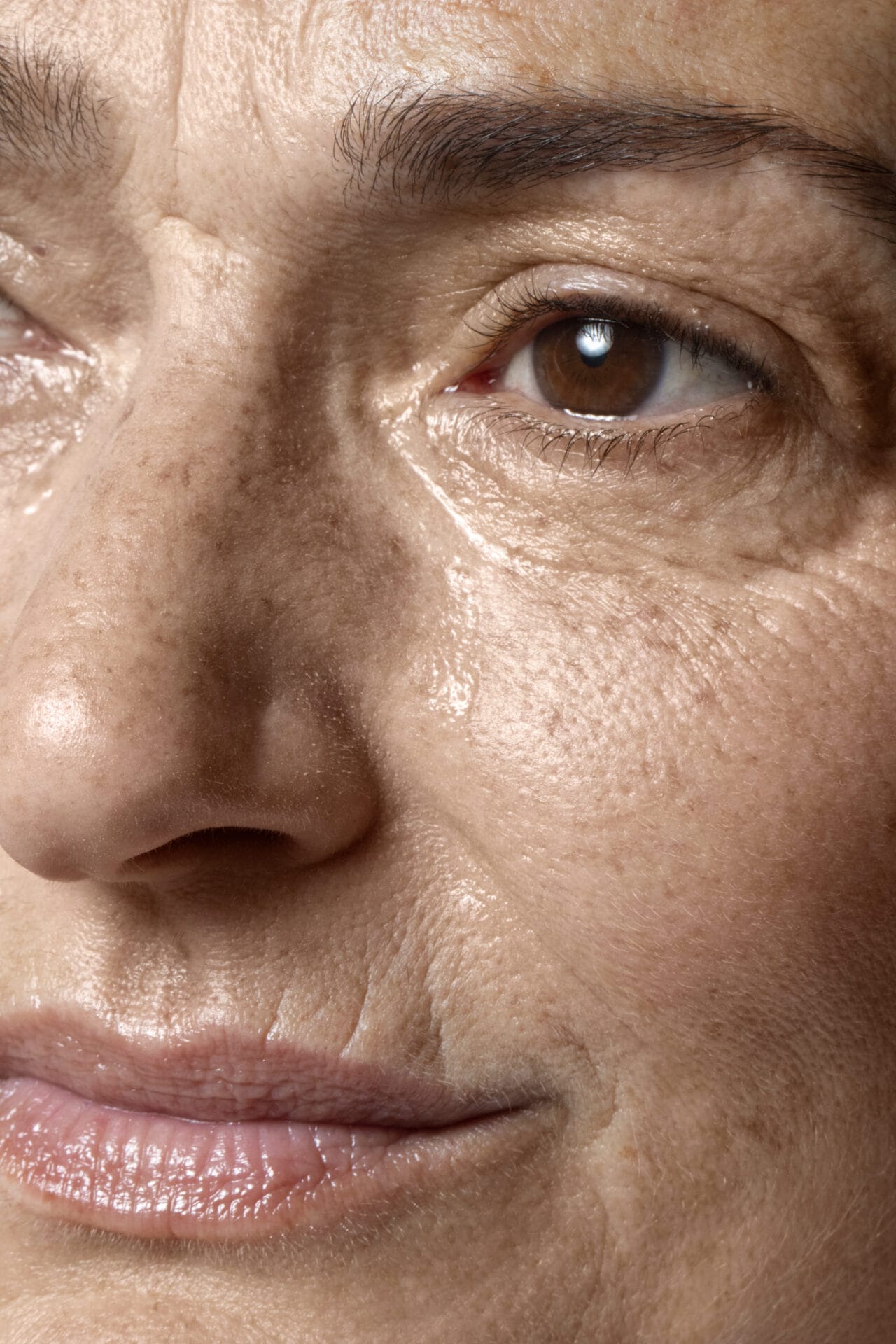 Enlarged facial pores and uneven skin texture