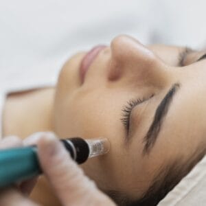 patient getting a professional microneedling treatment at dream med spa